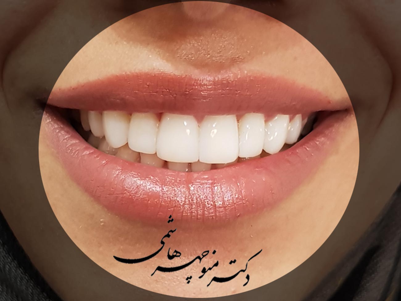 طراحی لبخند با لمینت