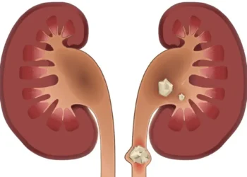 سنگ کلیه چه علائمی دارد؟
